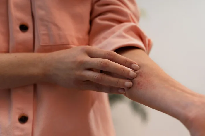 Skin Testing