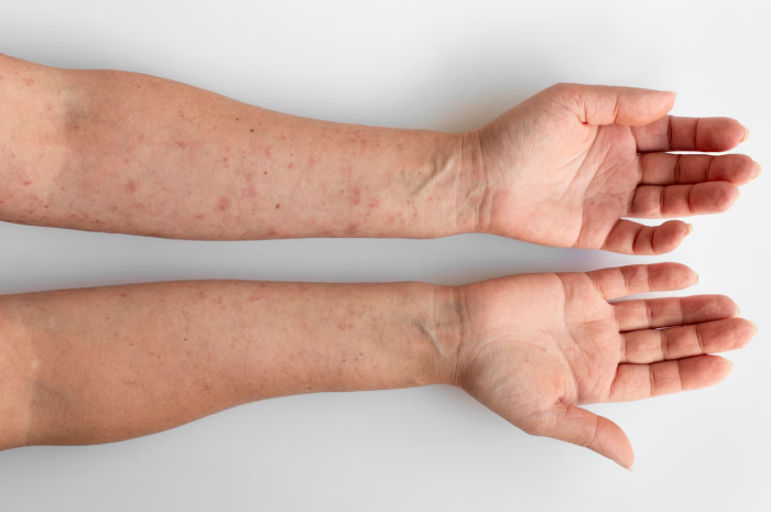 Dyshidrotic Eczema