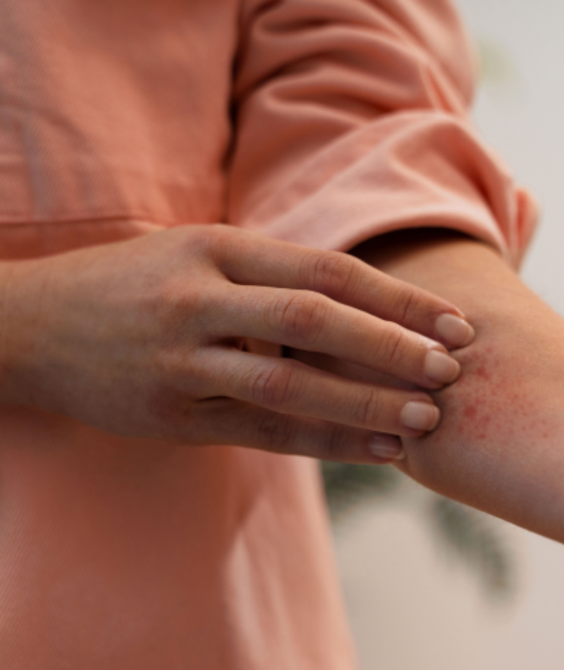 Treatment of Eczema