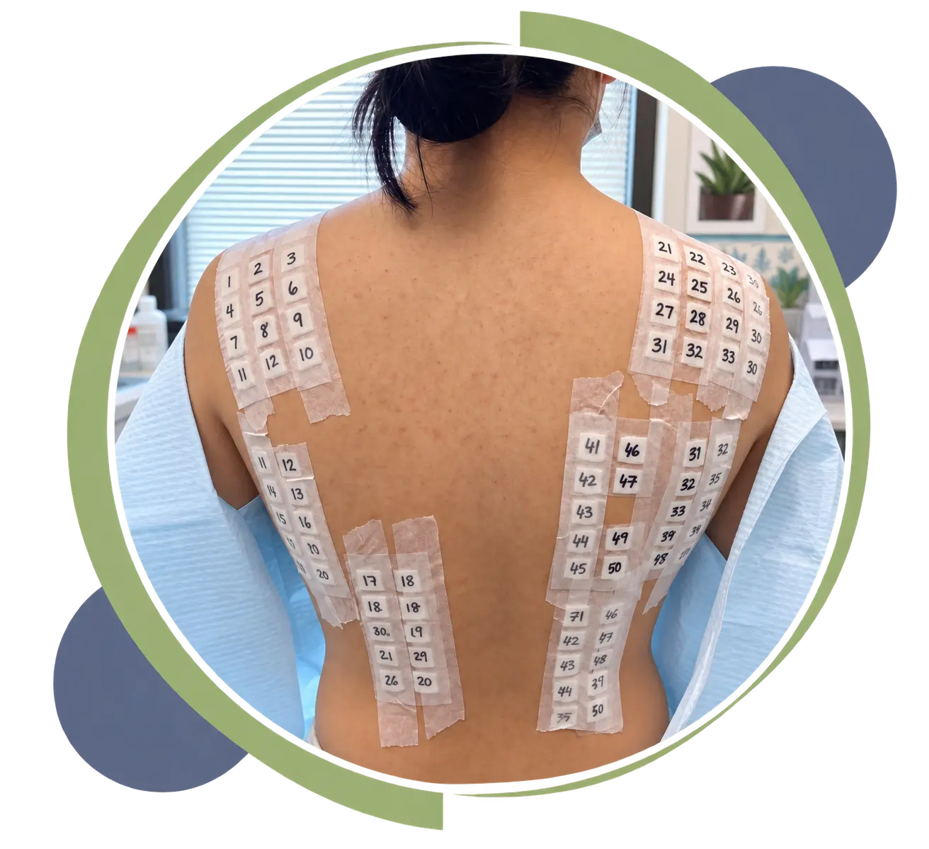 Allergy patch testing on a patient’s back during a clinical skin allergy assessment.